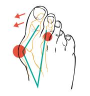 Korekční ponožky tejpovací na vbočený palec Compressana TAPE SOX Hallux valgus