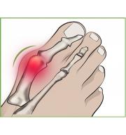 Chránič kloubu při vbočeném palci (hallux valgus) s gelovým polštářkem